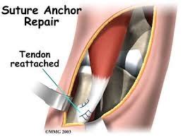 What is a Biceps Tendon Rupture and How is it Fixed?