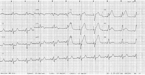 Sgarbossa Criteria • LITFL • ECG Library Diagnosis