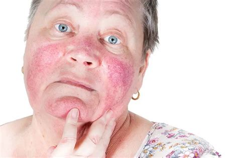 Red light Therapy and Rosacea:What you need to know. - Red Light Clinic