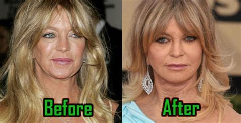 Goldie Hawn Plastic Surgery: Facelift, Injections, Before After ...