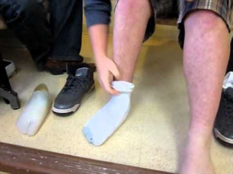 Partial Foot Prosthesis - YouTube