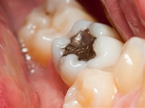 Environmental concerns about dental amalgam - Dentist Gloucester