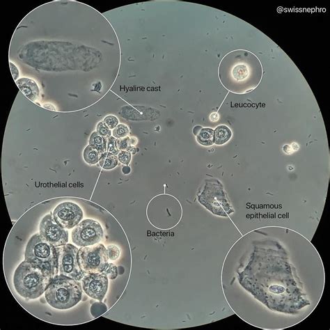 Urine potpourri (Phase contrast x400) #urinarysediment #urine # ...