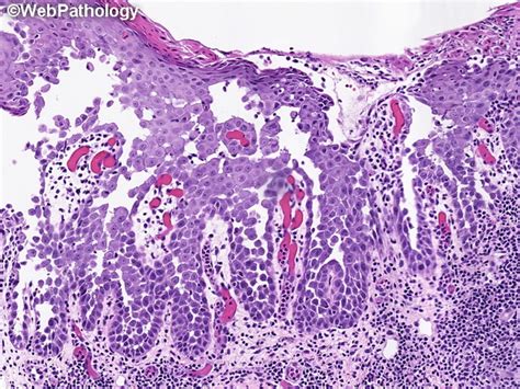 Webpathology.com: A Collection of Surgical Pathology Images