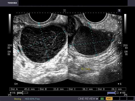 A Gallery of High-Resolution, Ultrasound, Color Doppler & 3D Images - ovaries | Diagnostic ...