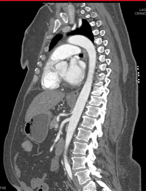 Achalasia - Esophagus Case Studies - CTisus CT Scanning