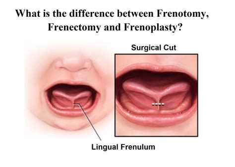 What is the difference between frenotomy, frenectomy and frenuloplasty ...