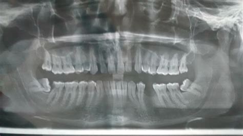 dentistry - Minimum treatment needed as per my full mouth xray - Health Stack Exchange