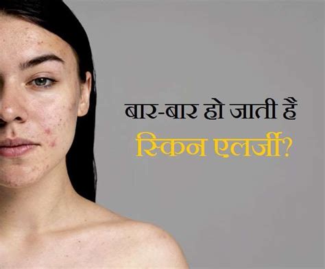 Skin Allergy Remedies: बार-बार होती है स्किन एलर्जी, तो ज़रूर आज़माएं के घरेलू नुस्खे - Skin ...