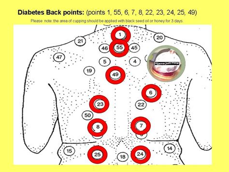 Diabetes Hijama Back points in full | Things for My Wall | Hijama points, Cupping therapy ...