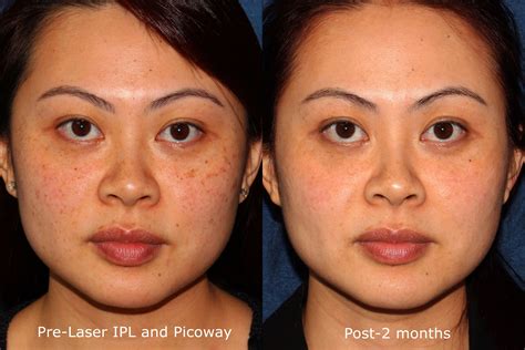 Best Before and After Dermatology Treatments in San Diego | CLDerm | Cosmetic dermatology, Laser ...