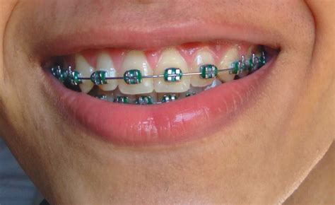 "Color Your Smile: Cool Braces Color Ideas to Consider"" healthy ...