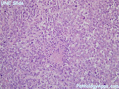 epithelioid sarcoma pathology