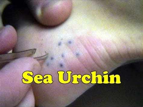 Sea Urchin Spines