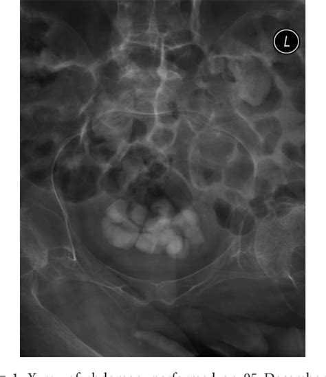 Figure 1 from Postoperative Complications Leading to Death after Coagulum Pyelolithotomy in a ...