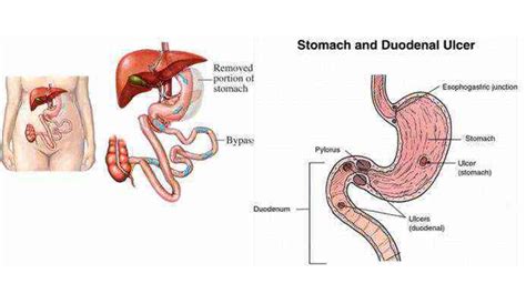 Duodenal Perforation Surgery in Aligarh, Duodenal Perforation Operation in UP