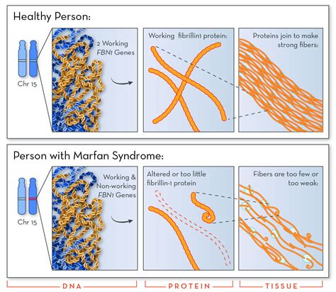 Marfan Syndrome