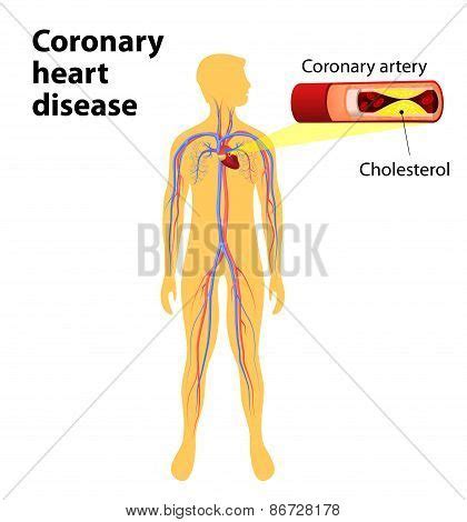 Coronary Heart Vector & Photo (Free Trial) | Bigstock