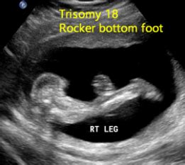 Gallery 5: Trisomy 18 | OB Images