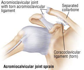 Shoulder Sprain Guide: Causes, Symptoms and Treatment Options