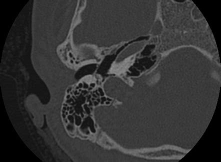 Myringosclerosis | Radiology Reference Article | Radiopaedia.org