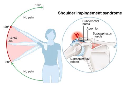 Shoulder Impingement Syndrome – First Choice Physical Therapy