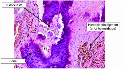 Osteitis Fibrosa Cystica Brown Tumor