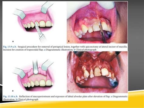 apicoectomy