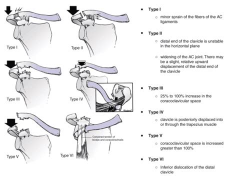 Acromioclavicular Joint Injury