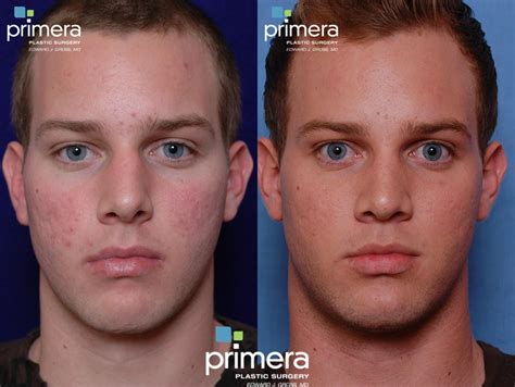 Rhinoplasty Before and After Pictures Case 80 | Orlando, Florida | Primera Plastic Surgery