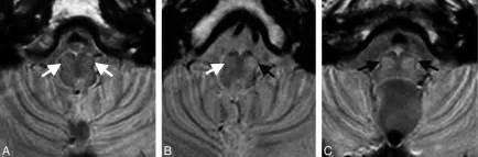 MR Imaging Evaluation of Inferior Olivary Nuclei: Comparison of ...