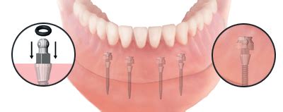 When Are Mini Dental Implants the Best Option? - Your Dental Health Resource