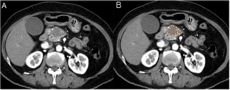 An example of quantitative texture analysis of the pancreas head... | Download Scientific Diagram