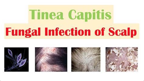 Discover more than 84 fungal infection hair loss super hot - in.eteachers