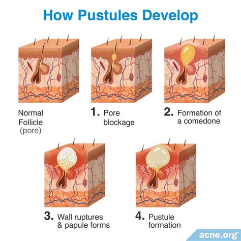 What Is an Acne Pustule? - Acne.org