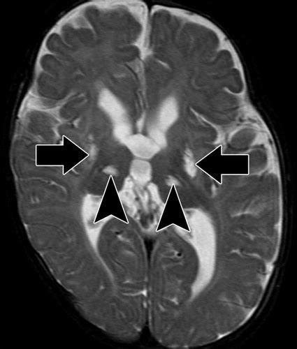 Hypoxic-Ischemic Brain Injury: Imaging Findings from Birth to Adulthood | RadioGraphics