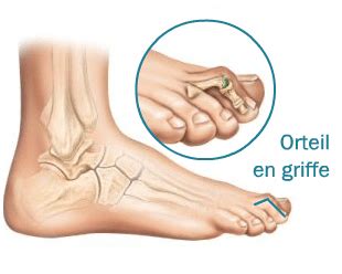 LES ORTEILS EN GRIFFE - Réflexologie Santé