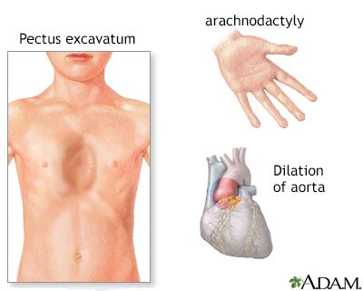 Marfan syndrome Information | Mount Sinai - New York