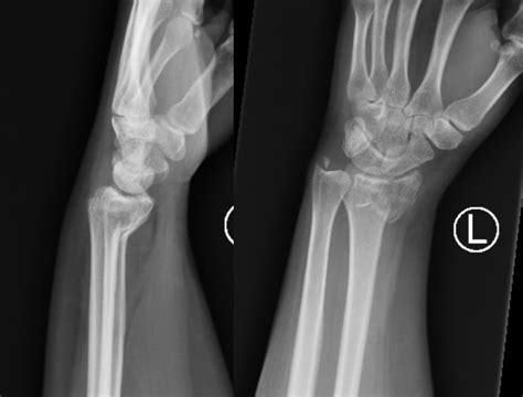 Smith Fracture Treatment | Smith Bone Fracture Surgery