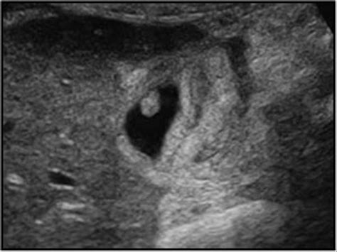 Abdomen and retroperitoneum | 1.2 Gallbladder and bile ducts : Case 1.2 ...