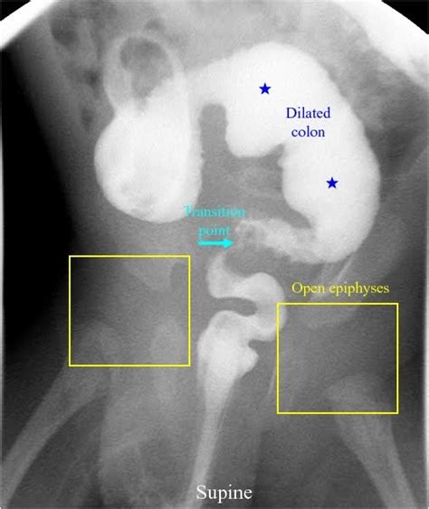 RadiologySpirit: Hirschsprung's Disease