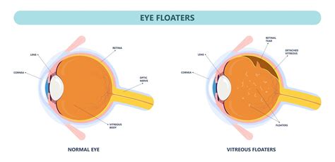 Understanding Eye Floaters: Causes, Meaning, and Treatment Options