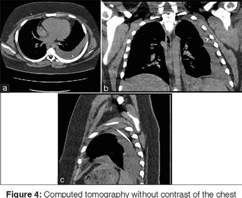 Figure 4 from Nuclear Medicine to Evaluate Complications of Cerebral Shunts: Two Cases and ...