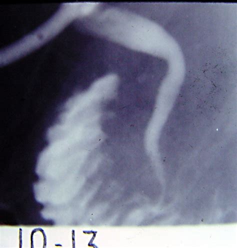 Biliary Stricture 1582 Bile Duct Stricture Pancreatitis 12 | Surgery Photos