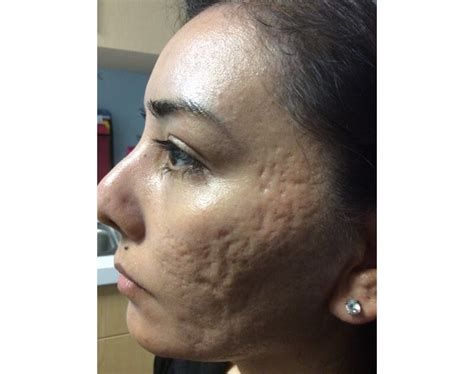 TCA Cross Chemical Peels Los Angeles - Dermatologist Dr. Ben Behnam