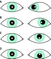 Background Information - Strabismus Divergens