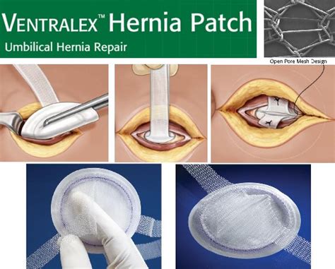 Prevention for hernia: 5 Tips for Preventing a Hernia