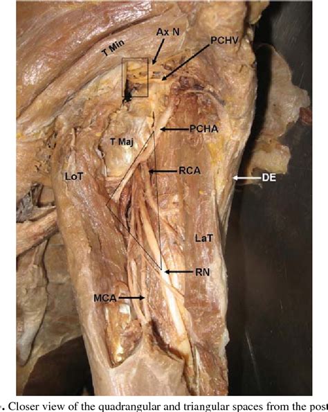 Figure 3 from Variant course of posterior circumflex humeral artery ...