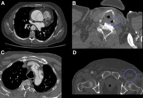 Midterm Outcomes of the Dissected Aorta Repair Through Stent ...