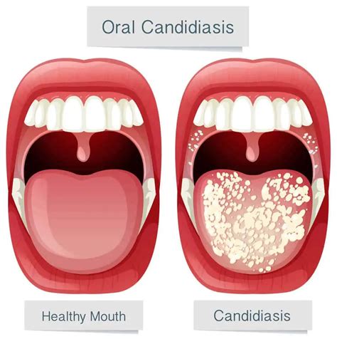 Candidiasis oral: ¿Cómo se contagia? Causas, síntomas y tratamientos